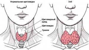 Строение щитовидки – норма и зоб