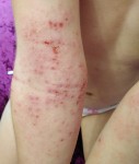 Аллергия у девочки 4-х лет – Руки