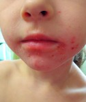 Аллергия у девочки 3-х лет – Лицо 